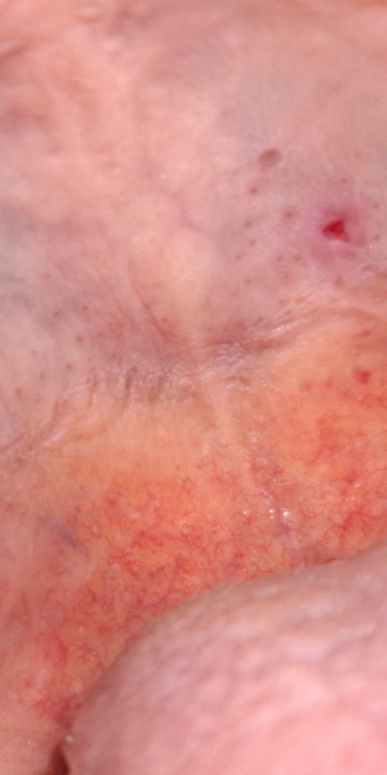 This is after brushing teeth and top of mouth with Dr. Bronner's peppermint soap and taking "Complete Papaya"  an anti-fibrolytic.